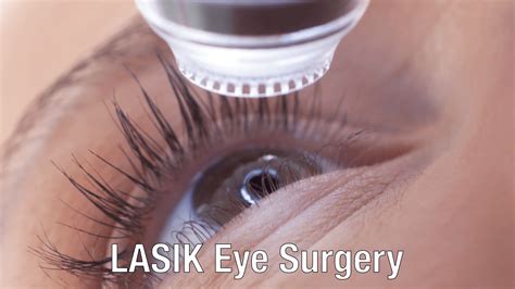 LASIK Eye Surgery