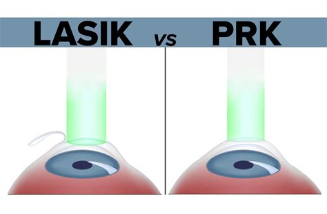 LASIK and PRK
