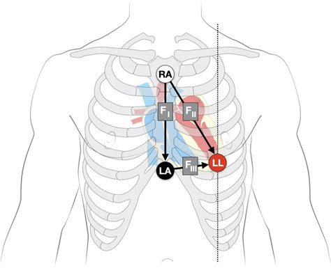 Lead III EKG placement