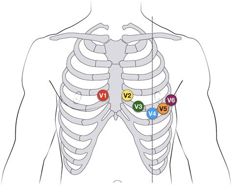 Lead V5 EKG placement