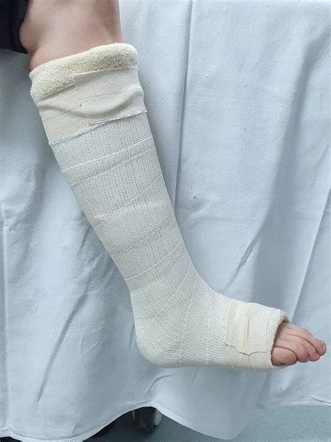 Leg Cast