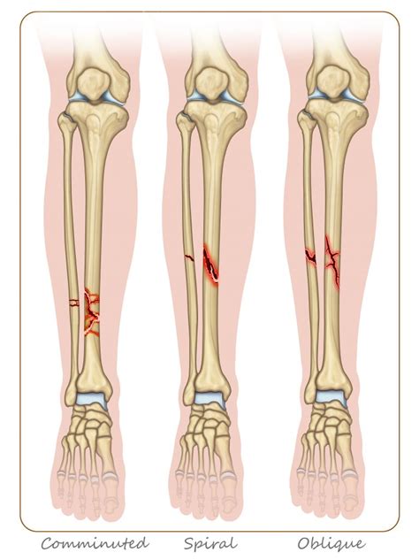 Leg Fracture