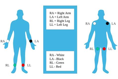 Limb lead placement diagram