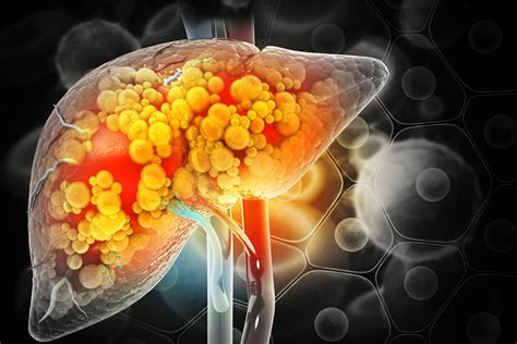 Liver disease