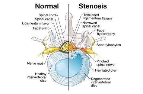 Lumbar Spinal Canal Stenosis