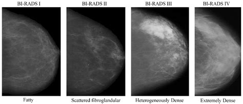 Mammography