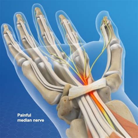 Median nerve compression