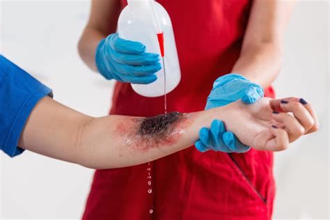 Medical Attention for Chemical Burns