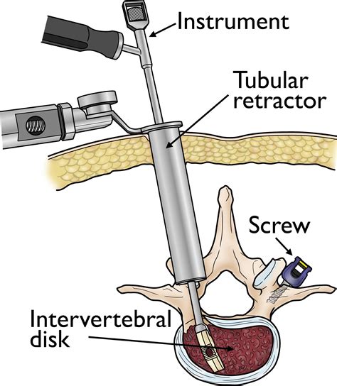 Minimally Invasive Spine Surgery