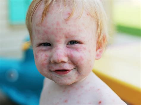 MMR vaccine rash