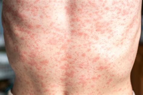 MMR vaccine rash symptoms