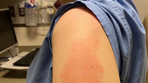 MMR vaccine rash treatment