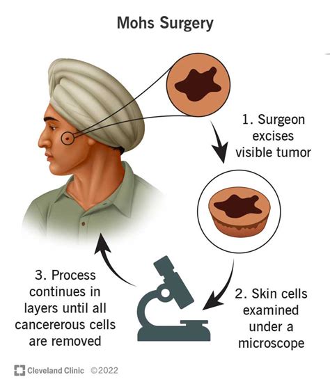 Mohs Surgery for Skin Cancer