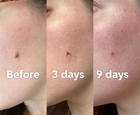 Mole removal