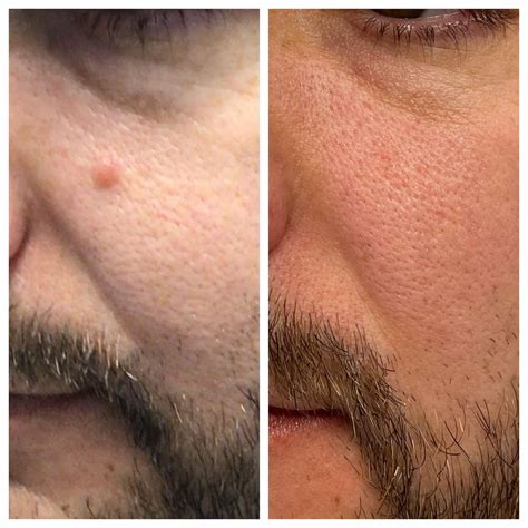 Mole removal methods