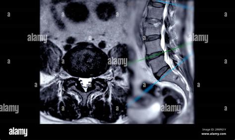 MRI Mechanism