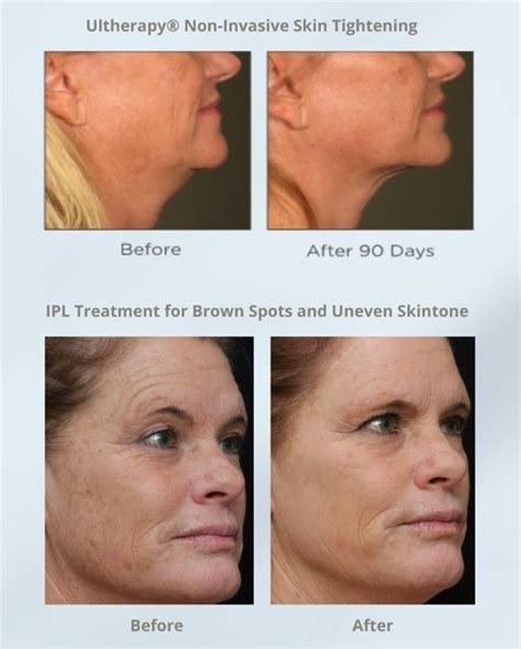 Non-Invasive Skin Rejuvenation