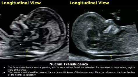Nuchal Fold Translucency Test Image
