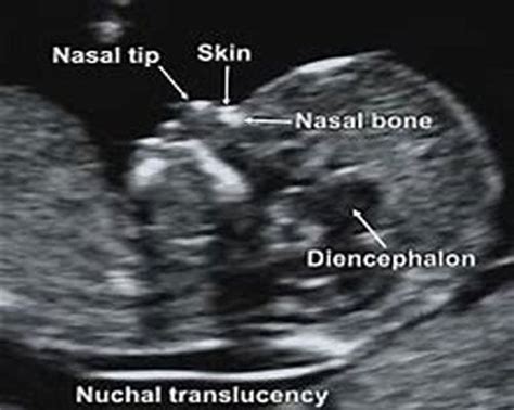 Nuchal Fold Translucency Test Benefits Image