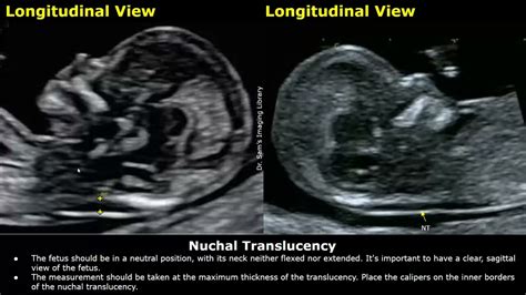 Nuchal Fold Translucency Test Results Image