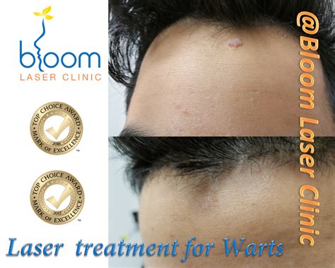 Occlusive therapy for wart removal