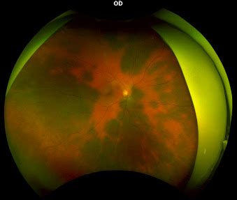 Ophthalmology