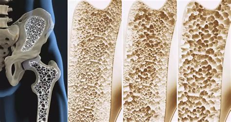 Osteoporosis