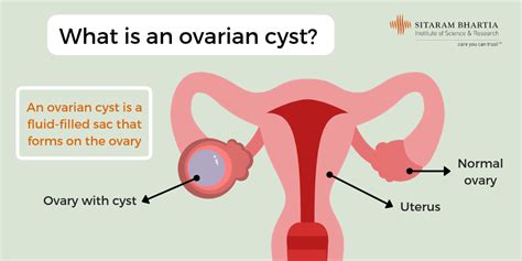 Ovarian Cyst Treatment
