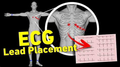 PCT Performing ECG
