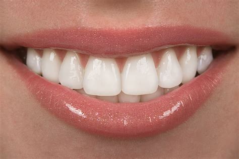 Perfect Smile