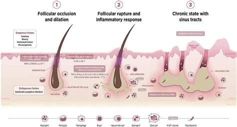 Perforating Follicular Occlusion