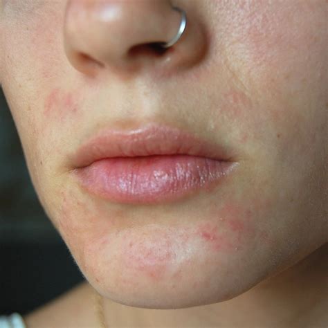 Perioral Dermatitis