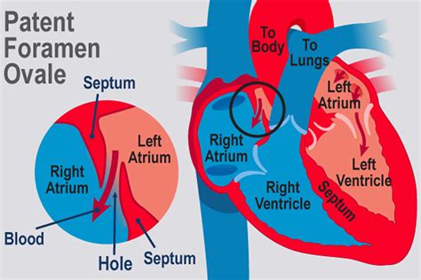 PFO Medical Abbreviation