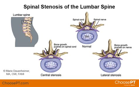 Physical Therapy for Lumbar Spinal Canal Stenosis