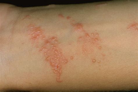 poison ivy rash blisters