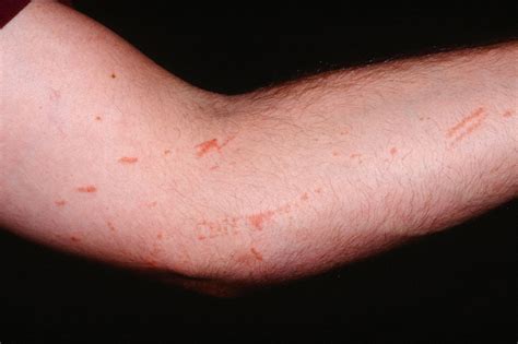 poison ivy rash identification