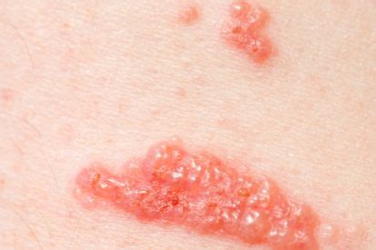 poison ivy rash medical attention