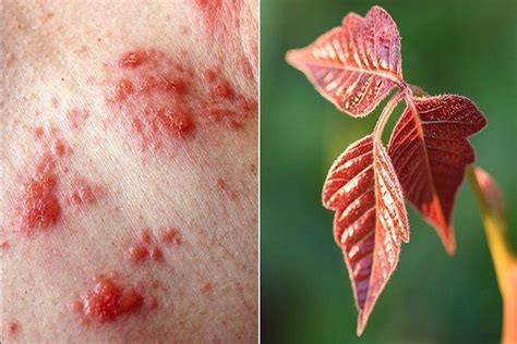 poison ivy rash patterns