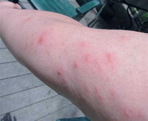 poison ivy rash redness
