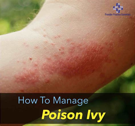 poison ivy rash unusual areas