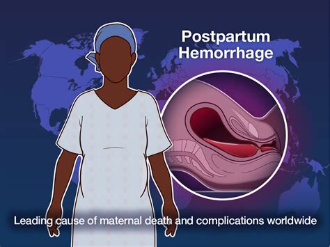Postpartum Hemorrhage