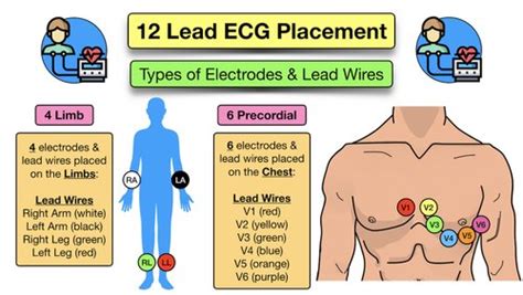 Precordial Electrodes