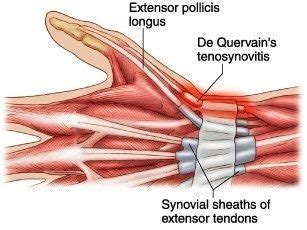 Preventing De Quervain's tenosynovitis