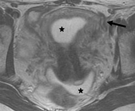 Primary Fallopian Occlusion