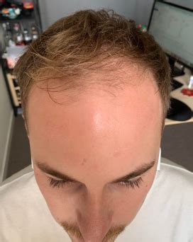 Propranolol Hair Loss