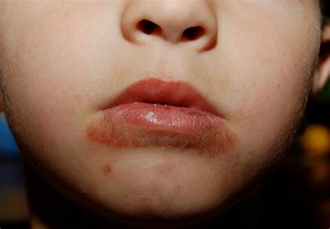 Rash around mouth