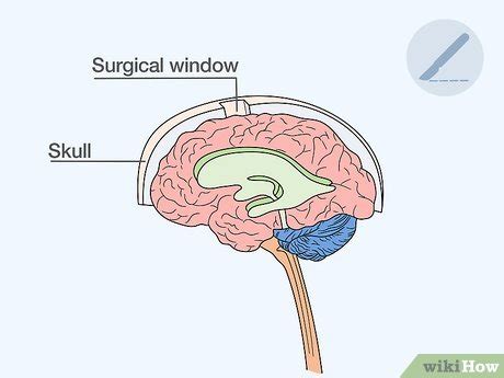Reducing Brain Swelling