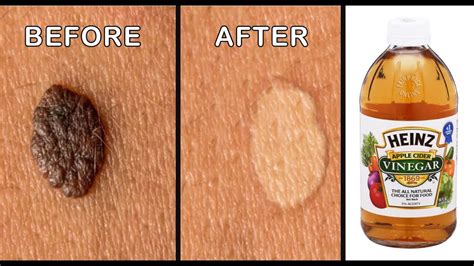 Remove Tag Moles Naturally