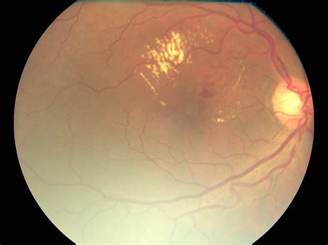 Retina and Macula Care