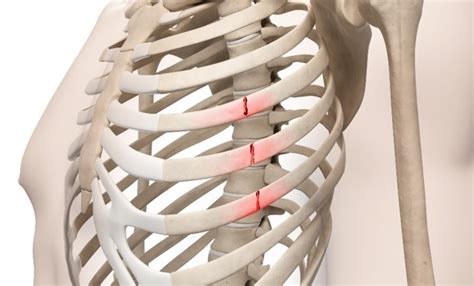 Rib Fracture Self-Care